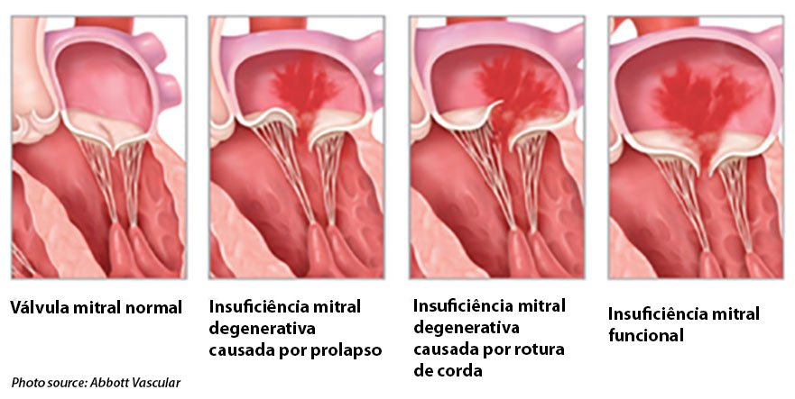 Nova evidência a favor do tratamento percutâneo da insuficiência mitral |  Casa de Saúde da Boavista